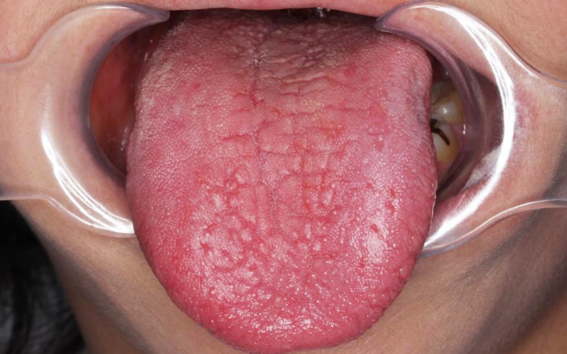 シェーグレン症候群患者の舌