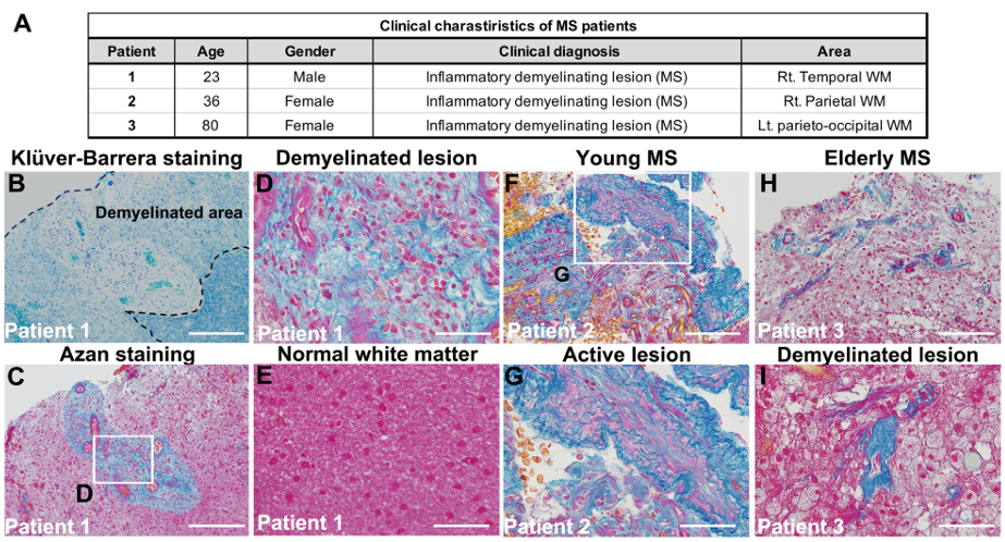 Type I collagen accumulation in lesions of patients with multiple sclerosis