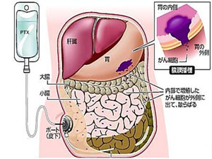 腹膜播種治療センター