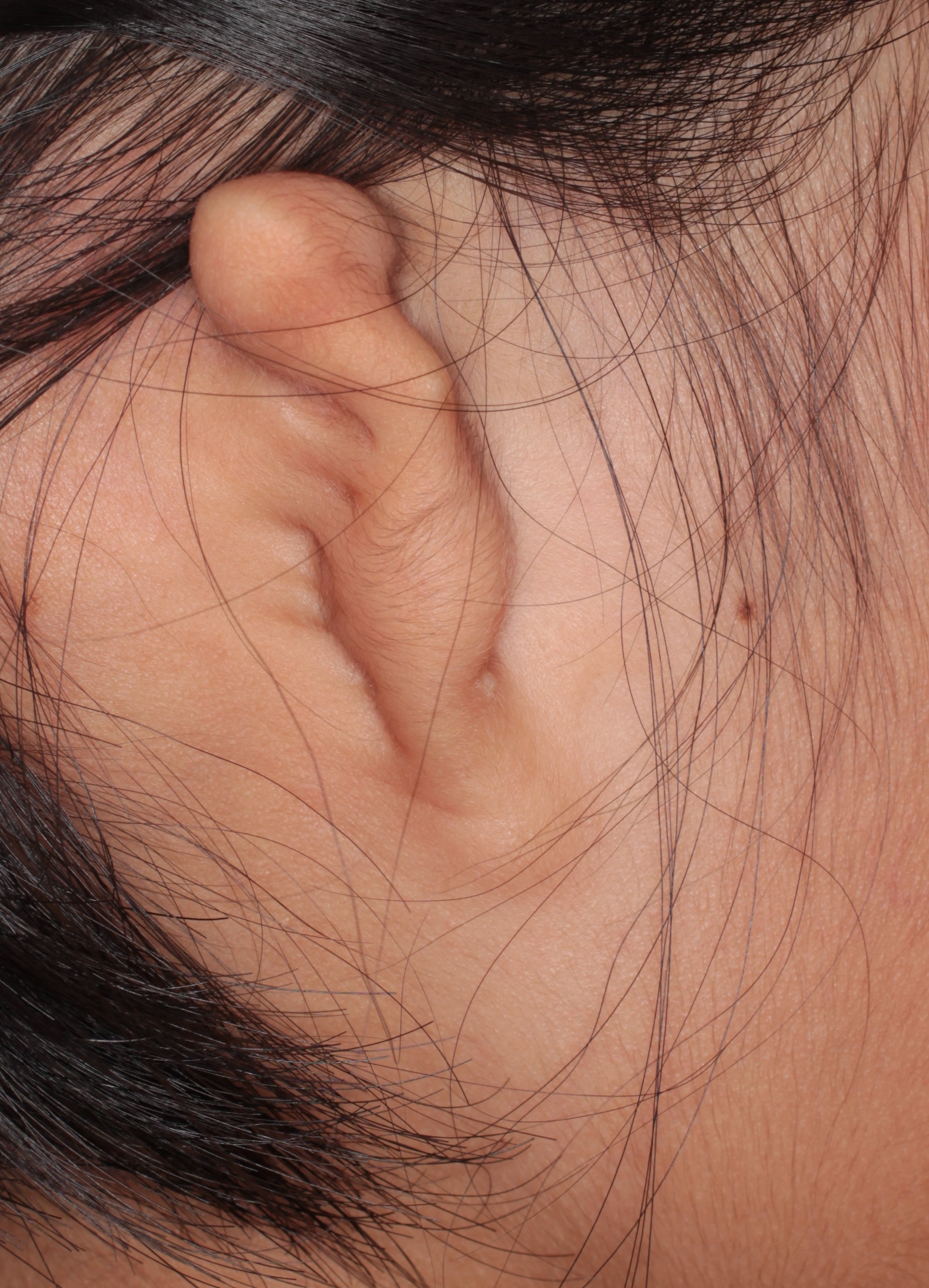 耳の裏の大きいほくろを切除しました。2か月目の経過。 | 豊洲佐藤クリニック