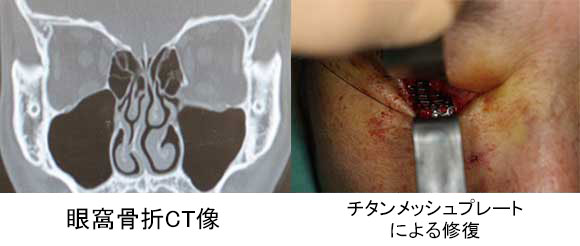 顔面骨骨折の治療自然医療薬学健康