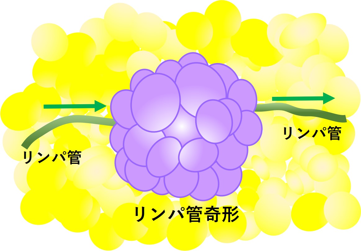 リンパ管奇形イメージ図