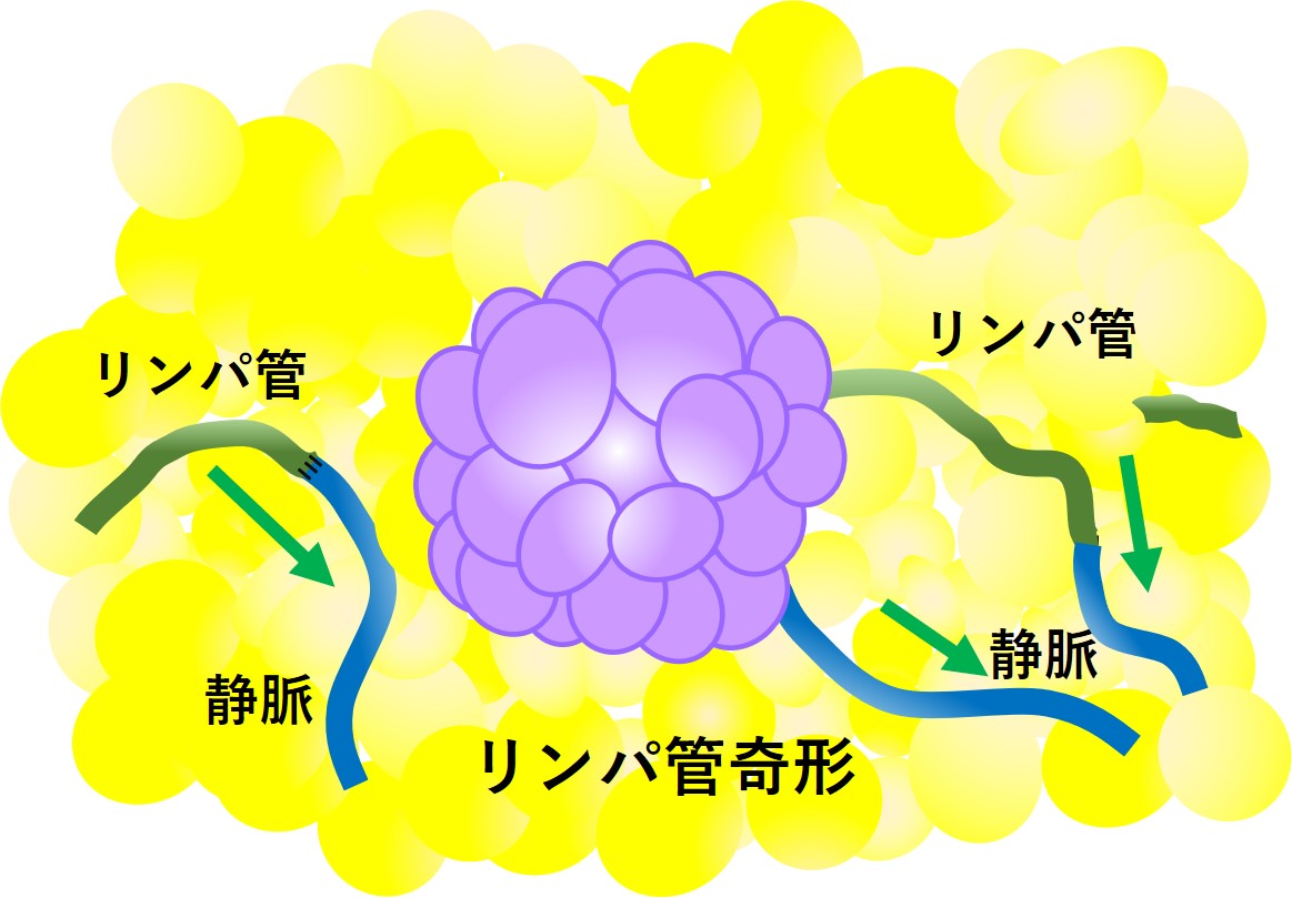 リンパ管細静脈吻合イメージ図