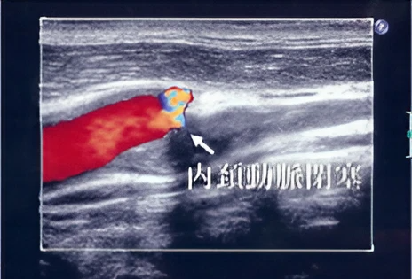 頸部血管エコー