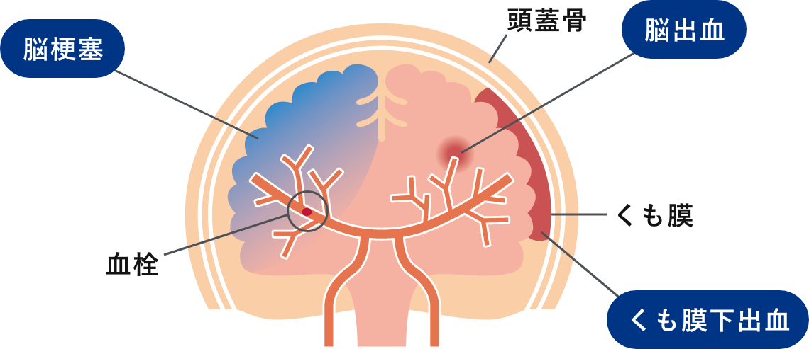 脳卒中とは