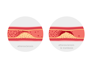 atherosclerosis atherosclerosis & trombosis pixta.jp - 18917784