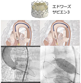 右冠動脈 左冠動脈 pixta.jp - 19431776
