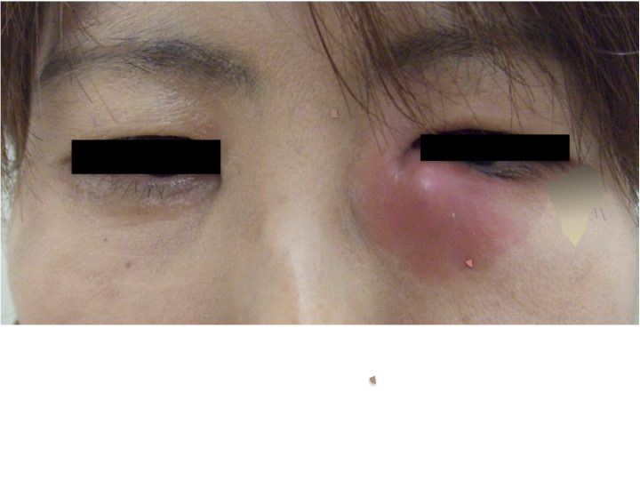各病気とその治療について 自治医科大学附属 さいたま医療センター 耳鼻咽喉 頭頸部外科