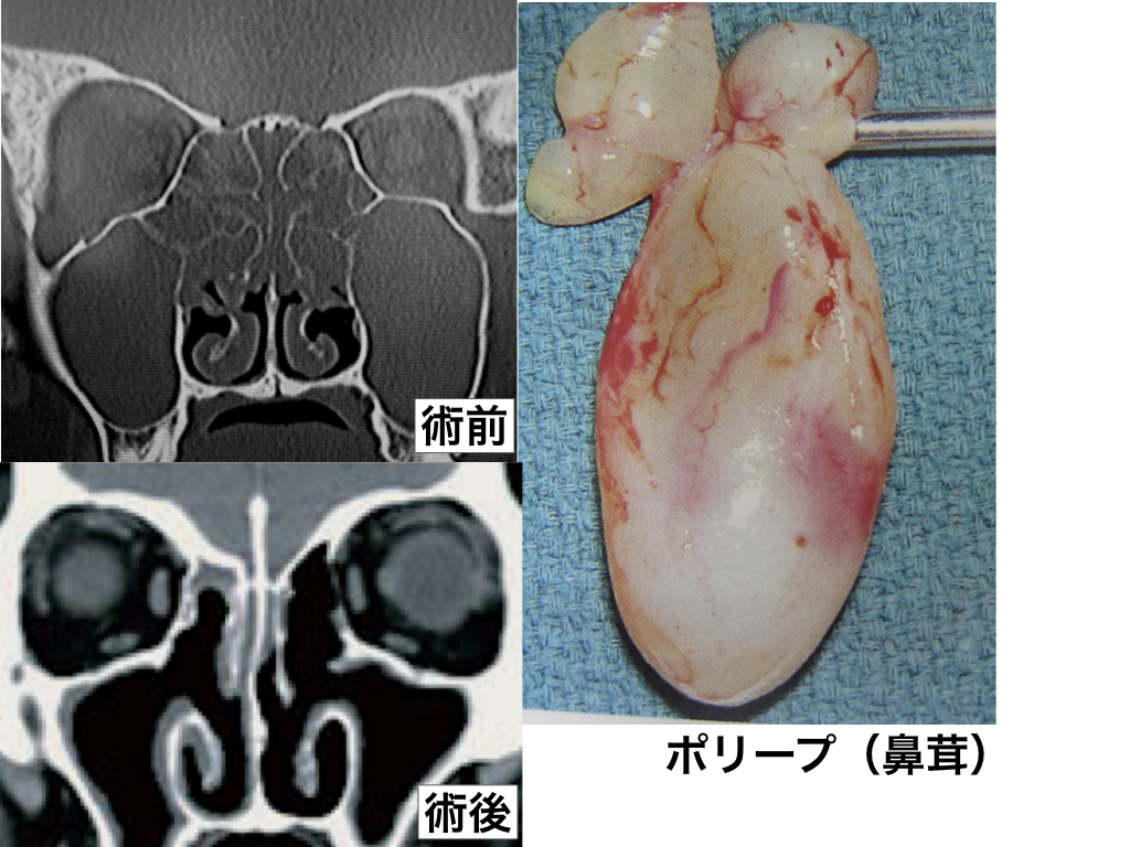 各病気とその治療について 自治医科大学附属 さいたま医療センター 耳鼻咽喉 頭頸部外科