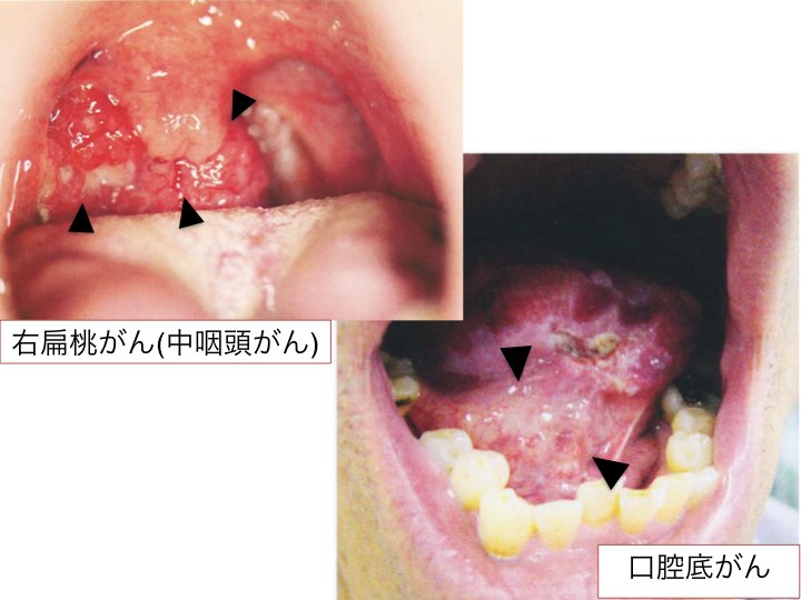 各病気とその治療について 自治医科大学附属 さいたま医療センター 耳鼻咽喉 頭頸部外科