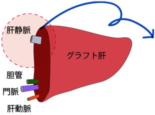 グラフト肝